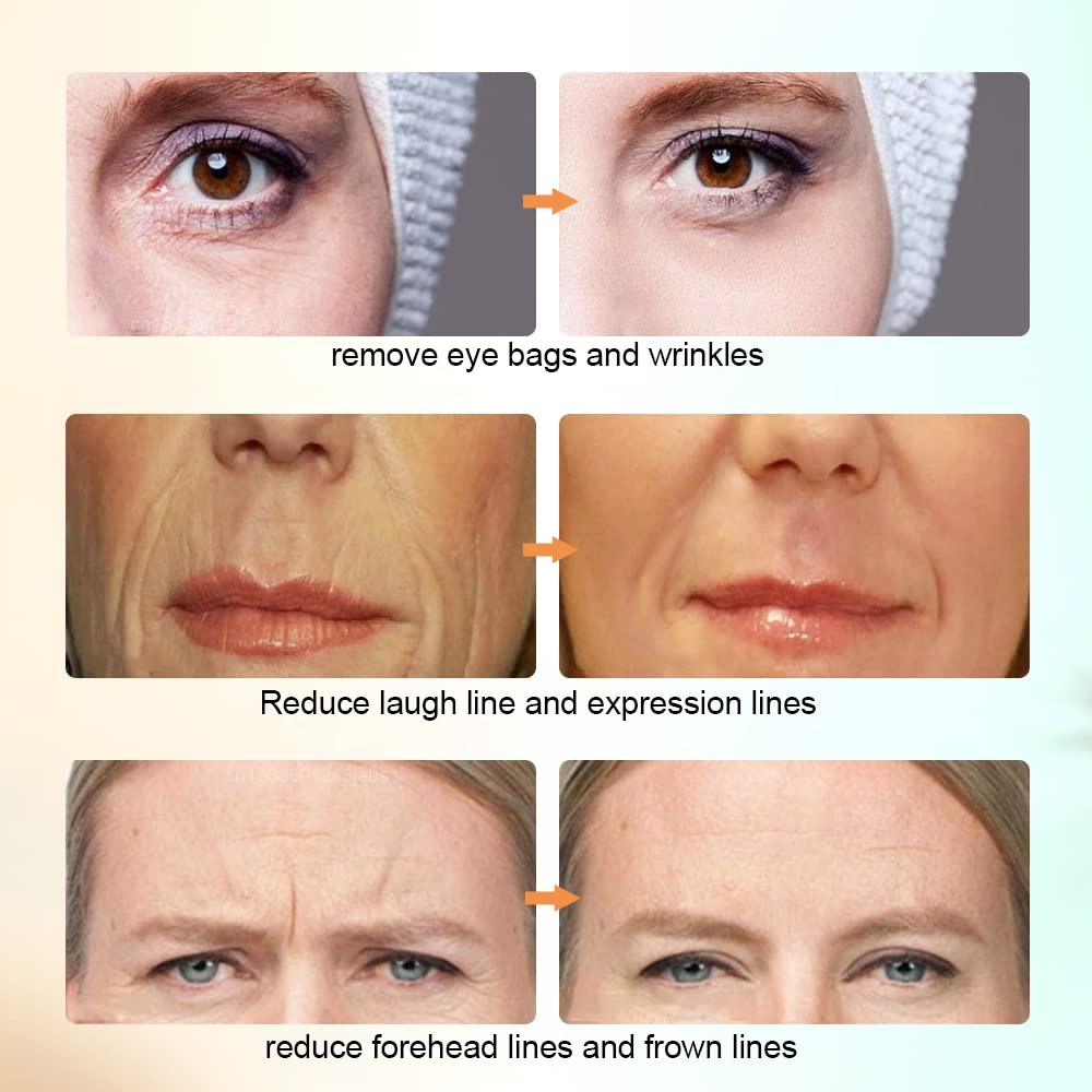 RF Skin Tightening Machine Face